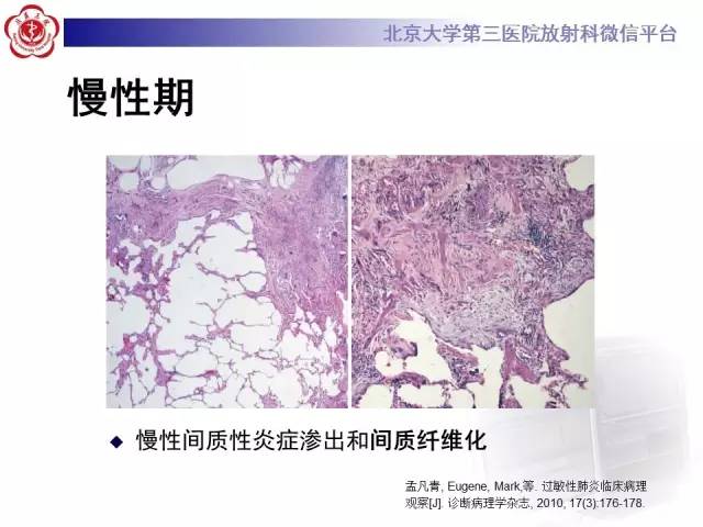【病例】过敏性肺炎1例CT影像表现