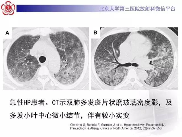 【病例】过敏性肺炎1例CT影像表现