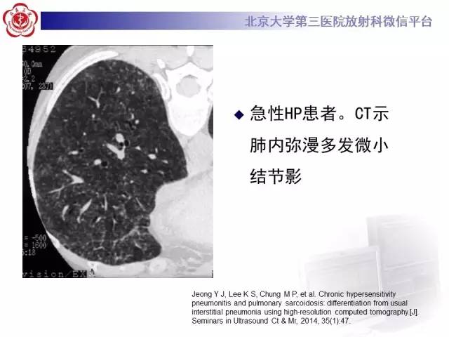 【病例】过敏性肺炎1例CT影像表现