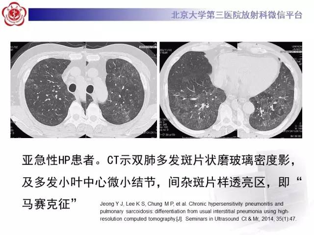 【病例】过敏性肺炎1例CT影像表现