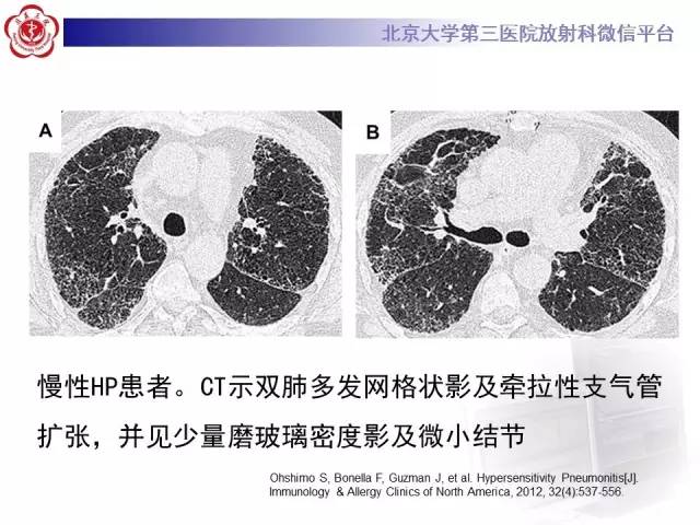 【病例】过敏性肺炎1例CT影像表现
