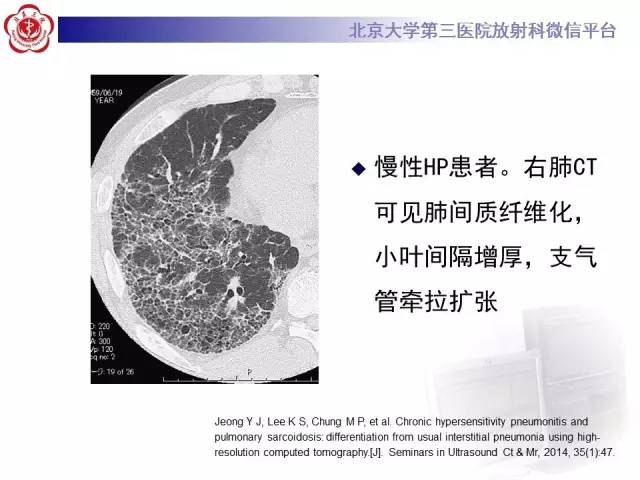 【病例】过敏性肺炎1例CT影像表现