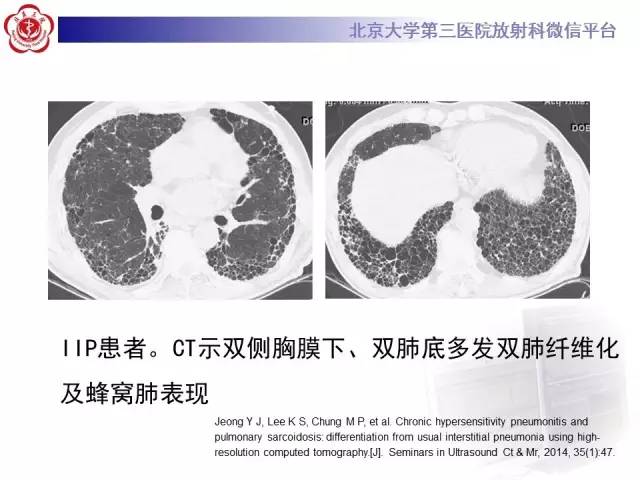 【病例】过敏性肺炎1例CT影像表现