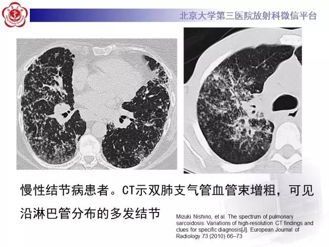 【病例】过敏性肺炎1例CT影像表现