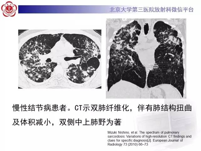 【病例】过敏性肺炎1例CT影像表现