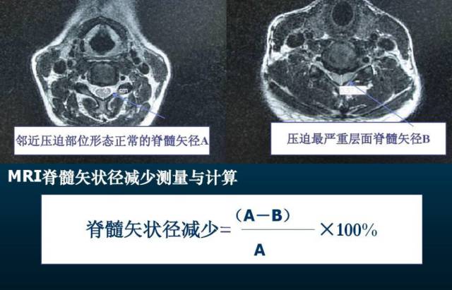 颈椎间盘MRI基本知识 颈椎间盘MRI基本知识