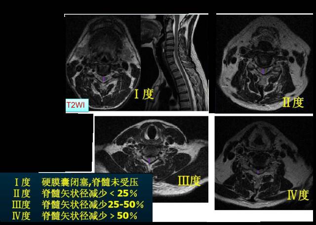 颈椎间盘MRI基本知识 颈椎间盘MRI基本知识