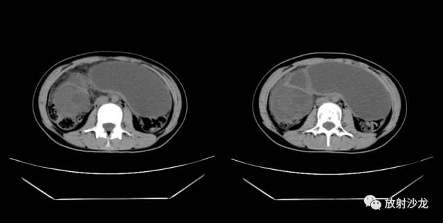 【病例】右侧卵巢粘液性囊性腺纤维瘤1例CT