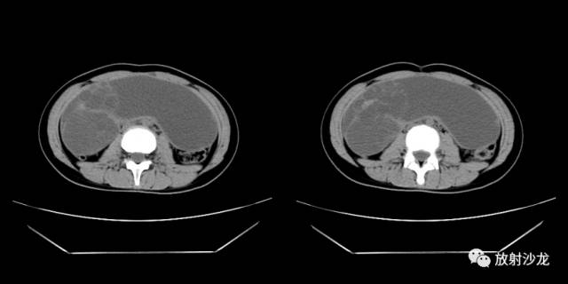 【病例】右侧卵巢粘液性囊性腺纤维瘤1例CT 【病例】右侧卵巢粘液性囊性腺纤维瘤1例CT