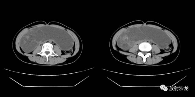 【病例】右侧卵巢粘液性囊性腺纤维瘤1例CT 【病例】右侧卵巢粘液性囊性腺纤维瘤1例CT