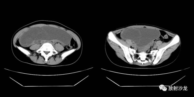 【病例】右侧卵巢粘液性囊性腺纤维瘤1例CT 【病例】右侧卵巢粘液性囊性腺纤维瘤1例CT