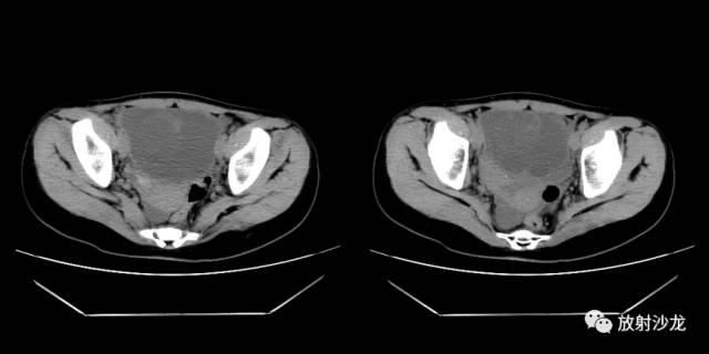 【病例】右侧卵巢粘液性囊性腺纤维瘤1例CT 【病例】右侧卵巢粘液性囊性腺纤维瘤1例CT