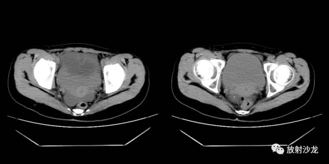 【病例】右侧卵巢粘液性囊性腺纤维瘤1例CT 【病例】右侧卵巢粘液性囊性腺纤维瘤1例CT