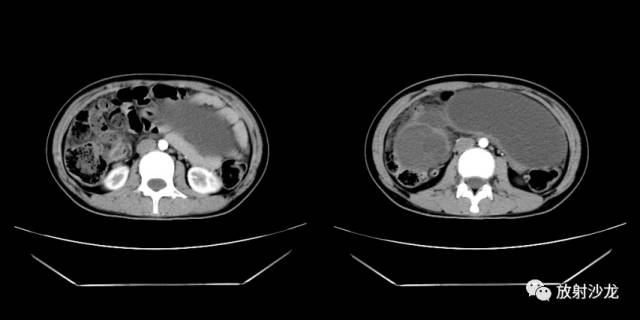 【病例】右侧卵巢粘液性囊性腺纤维瘤1例CT 【病例】右侧卵巢粘液性囊性腺纤维瘤1例CT