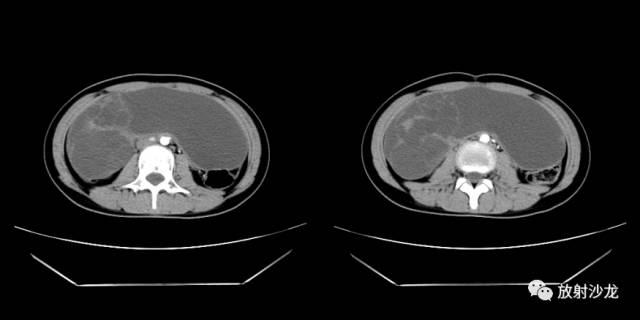 【病例】右侧卵巢粘液性囊性腺纤维瘤1例CT 【病例】右侧卵巢粘液性囊性腺纤维瘤1例CT