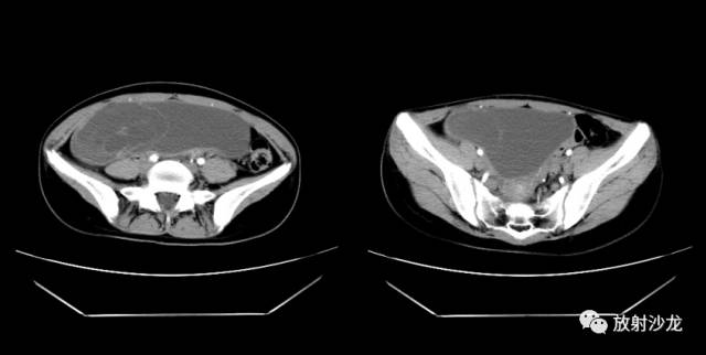 【病例】右侧卵巢粘液性囊性腺纤维瘤1例CT 【病例】右侧卵巢粘液性囊性腺纤维瘤1例CT
