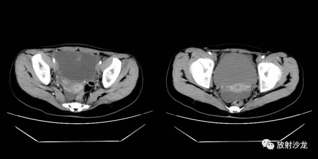【病例】右侧卵巢粘液性囊性腺纤维瘤1例CT 【病例】右侧卵巢粘液性囊性腺纤维瘤1例CT