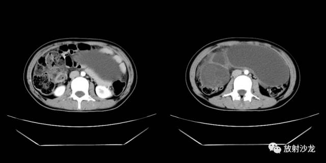 【病例】右侧卵巢粘液性囊性腺纤维瘤1例CT 【病例】右侧卵巢粘液性囊性腺纤维瘤1例CT