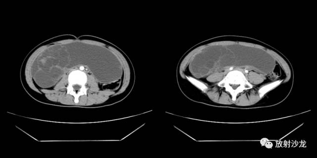 【病例】右侧卵巢粘液性囊性腺纤维瘤1例CT 【病例】右侧卵巢粘液性囊性腺纤维瘤1例CT
