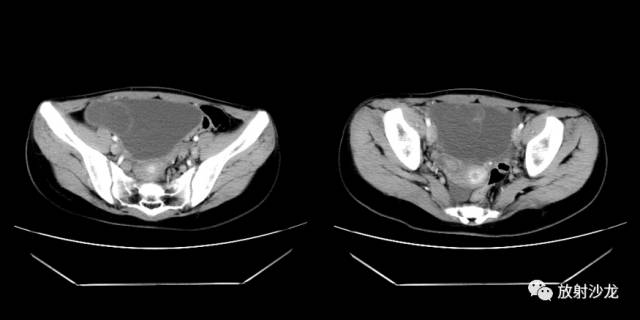 【病例】右侧卵巢粘液性囊性腺纤维瘤1例CT 【病例】右侧卵巢粘液性囊性腺纤维瘤1例CT