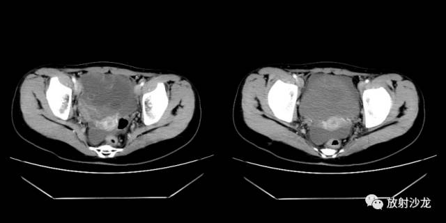 【病例】右侧卵巢粘液性囊性腺纤维瘤1例CT 【病例】右侧卵巢粘液性囊性腺纤维瘤1例CT