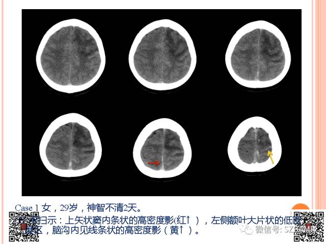 【PPT】急性静脉窦血栓形成影像检查