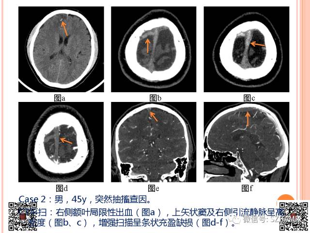 【PPT】急性静脉窦血栓形成影像检查