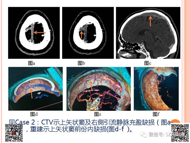 【PPT】急性静脉窦血栓形成影像检查