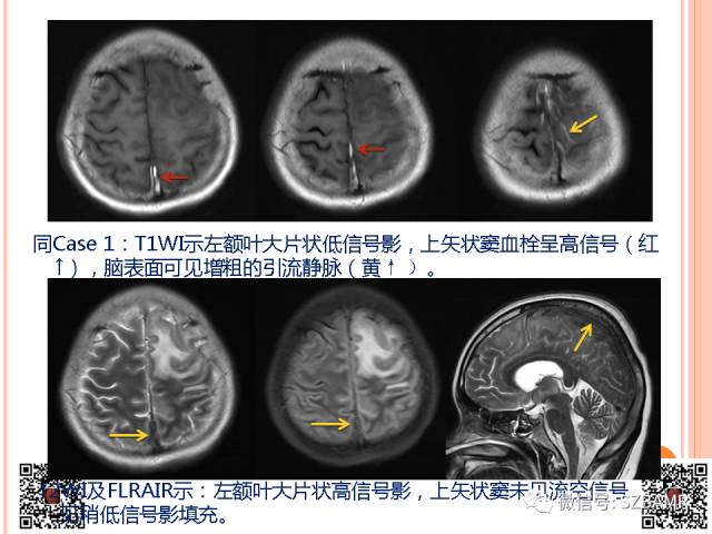 【PPT】急性静脉窦血栓形成影像检查