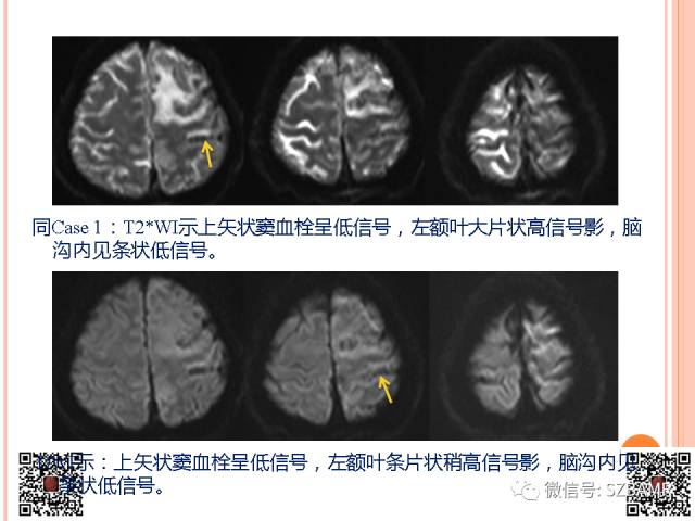 【PPT】急性静脉窦血栓形成影像检查