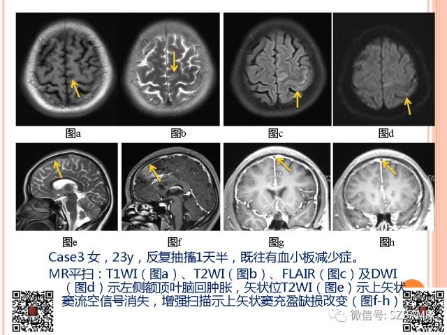 【PPT】急性静脉窦血栓形成影像检查