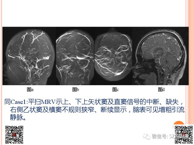 【PPT】急性静脉窦血栓形成影像检查