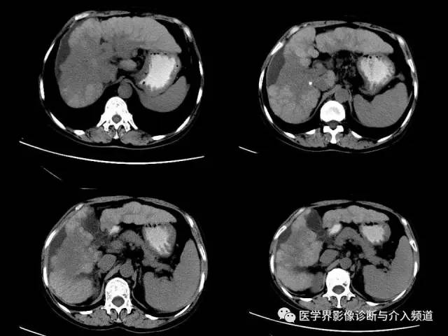 【病例】肝融合性纤维化1例CT及MR影像表现