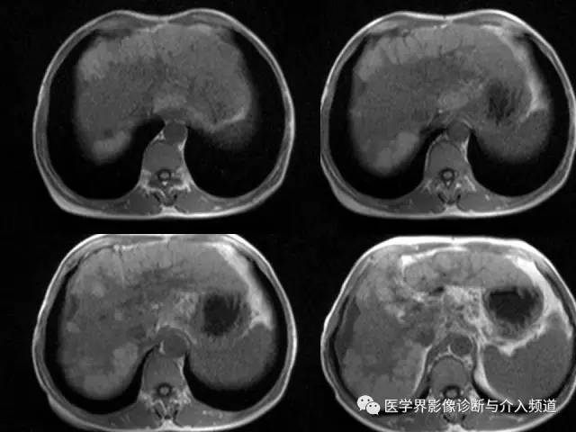 【病例】肝融合性纤维化1例CT及MR影像表现