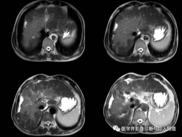 【病例】肝融合性纤维化1例CT及MR影像表现