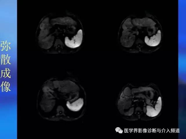 【病例】肝融合性纤维化1例CT及MR影像表现