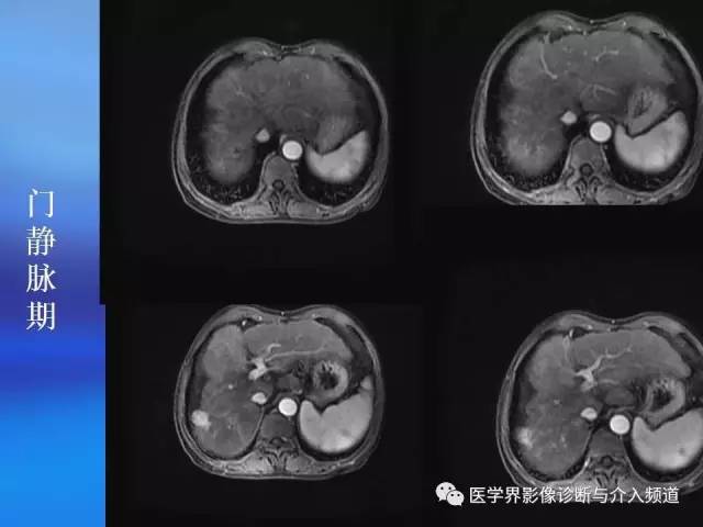 【病例】肝融合性纤维化1例CT及MR影像表现