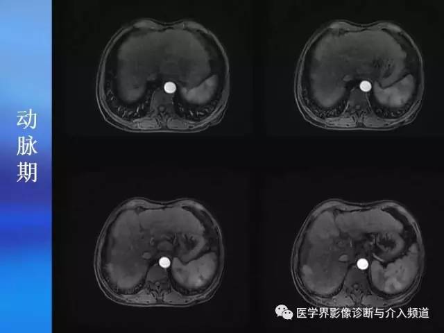 【病例】肝融合性纤维化1例CT及MR影像表现