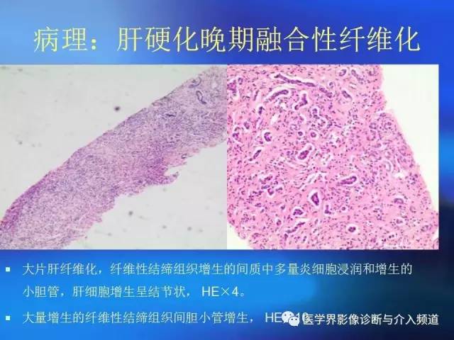 【病例】肝融合性纤维化1例CT及MR影像表现