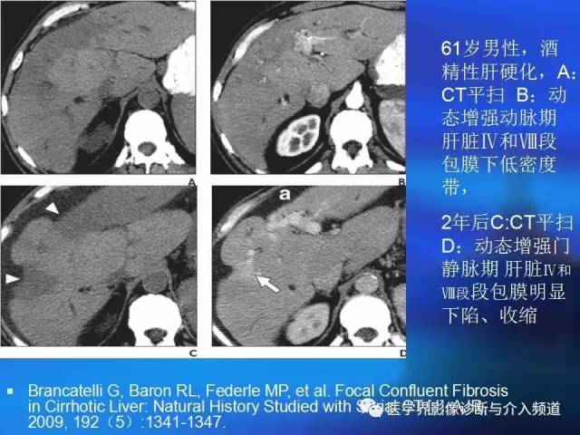 【病例】肝融合性纤维化1例CT及MR影像表现