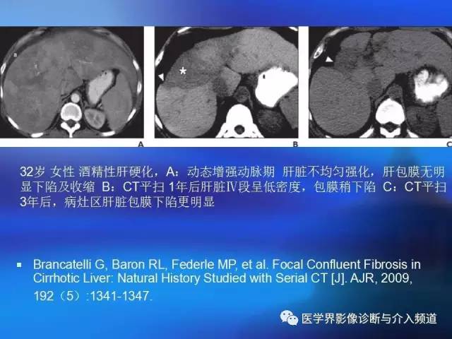 【病例】肝融合性纤维化1例CT及MR影像表现