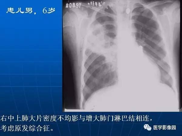 【PPT】各型肺结核的典型影像表现