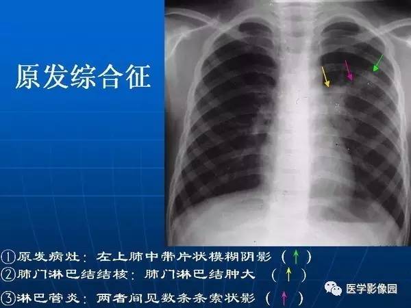 【PPT】各型肺结核的典型影像表现