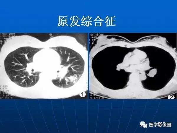 【PPT】各型肺结核的典型影像表现