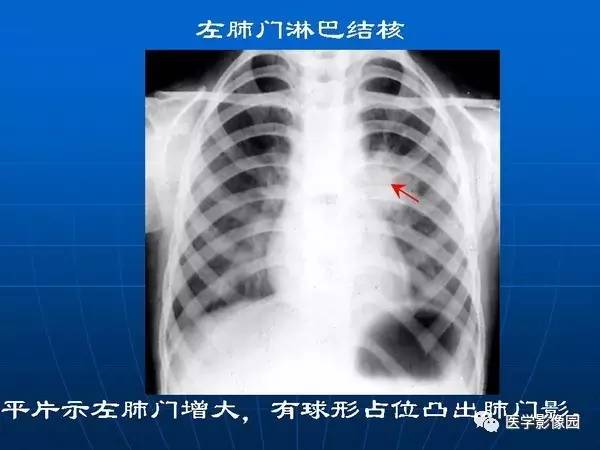 【PPT】各型肺结核的典型影像表现