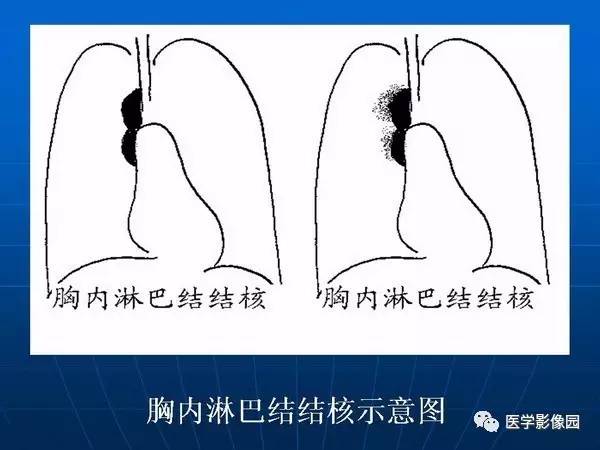 【PPT】各型肺结核的典型影像表现