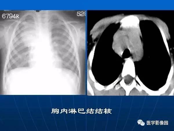 【PPT】各型肺结核的典型影像表现