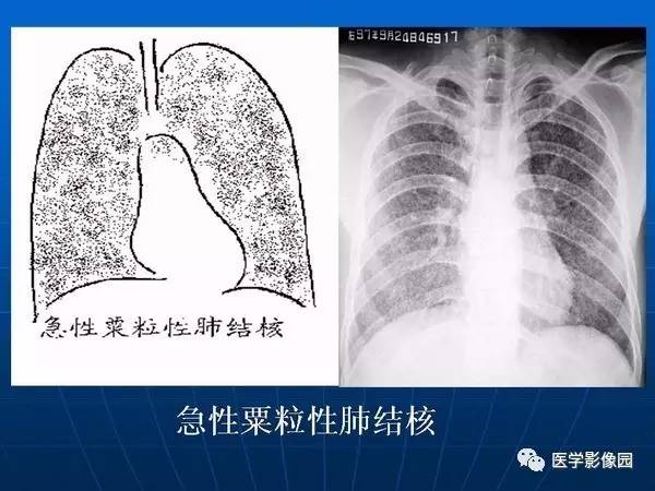 【PPT】各型肺结核的典型影像表现