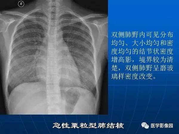 【PPT】各型肺结核的典型影像表现