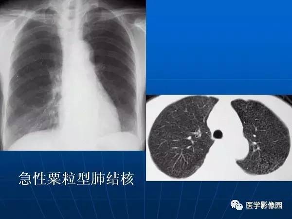 【PPT】各型肺结核的典型影像表现
